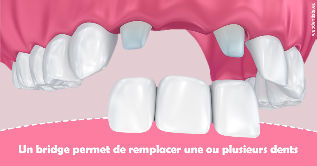 https://dr-doucet-philippe.chirurgiens-dentistes.fr/Bridge remplacer dents 2