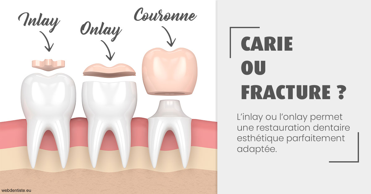 https://dr-doucet-philippe.chirurgiens-dentistes.fr/T2 2023 - Carie ou fracture 1