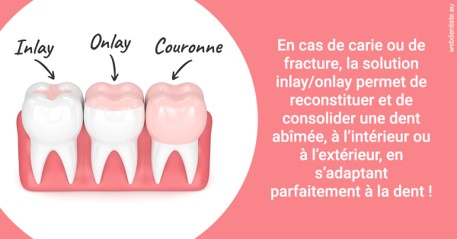 https://dr-doucet-philippe.chirurgiens-dentistes.fr/L'INLAY ou l'ONLAY 2