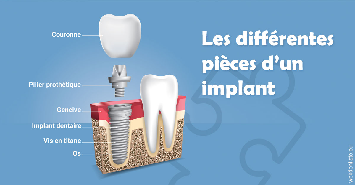 https://dr-doucet-philippe.chirurgiens-dentistes.fr/Les différentes pièces d’un implant 1